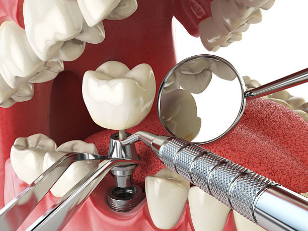 Best Urgent Care for Lost Fillings or Crowns in Rendon, TX